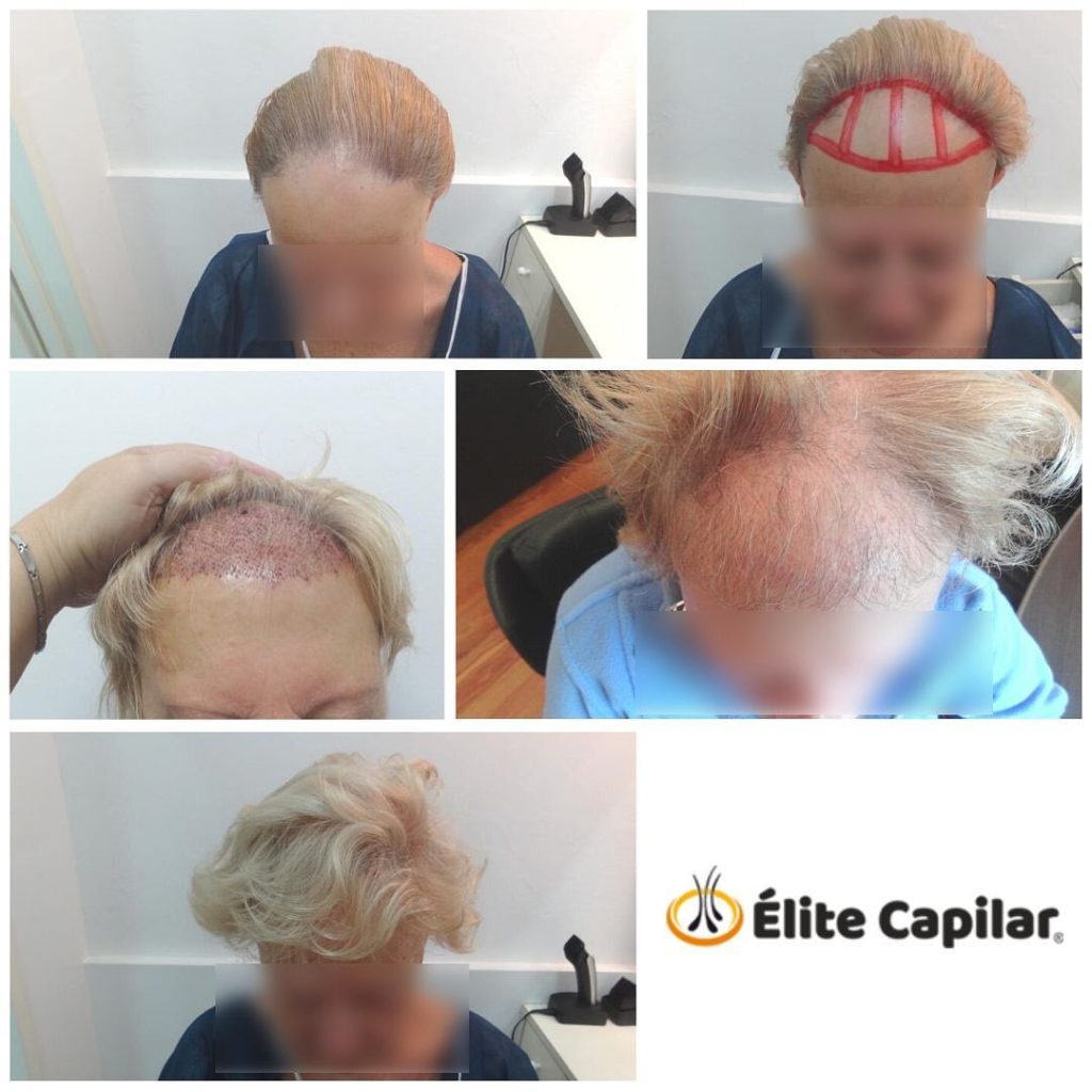 Trasplante Capilar A Los 50 Años Trasplante Capilar en Mujeres | Élite Capilar | Clínica Recuperación