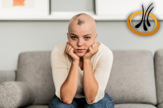 alopecia en jovenes